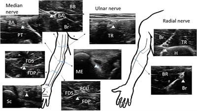 Cross-Sectional Area Reference Values for Sonography of Peripheral Nerves in Taiwanese Adults